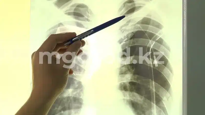 В Уральске выросла заболеваемость туберкулёзом среди детей