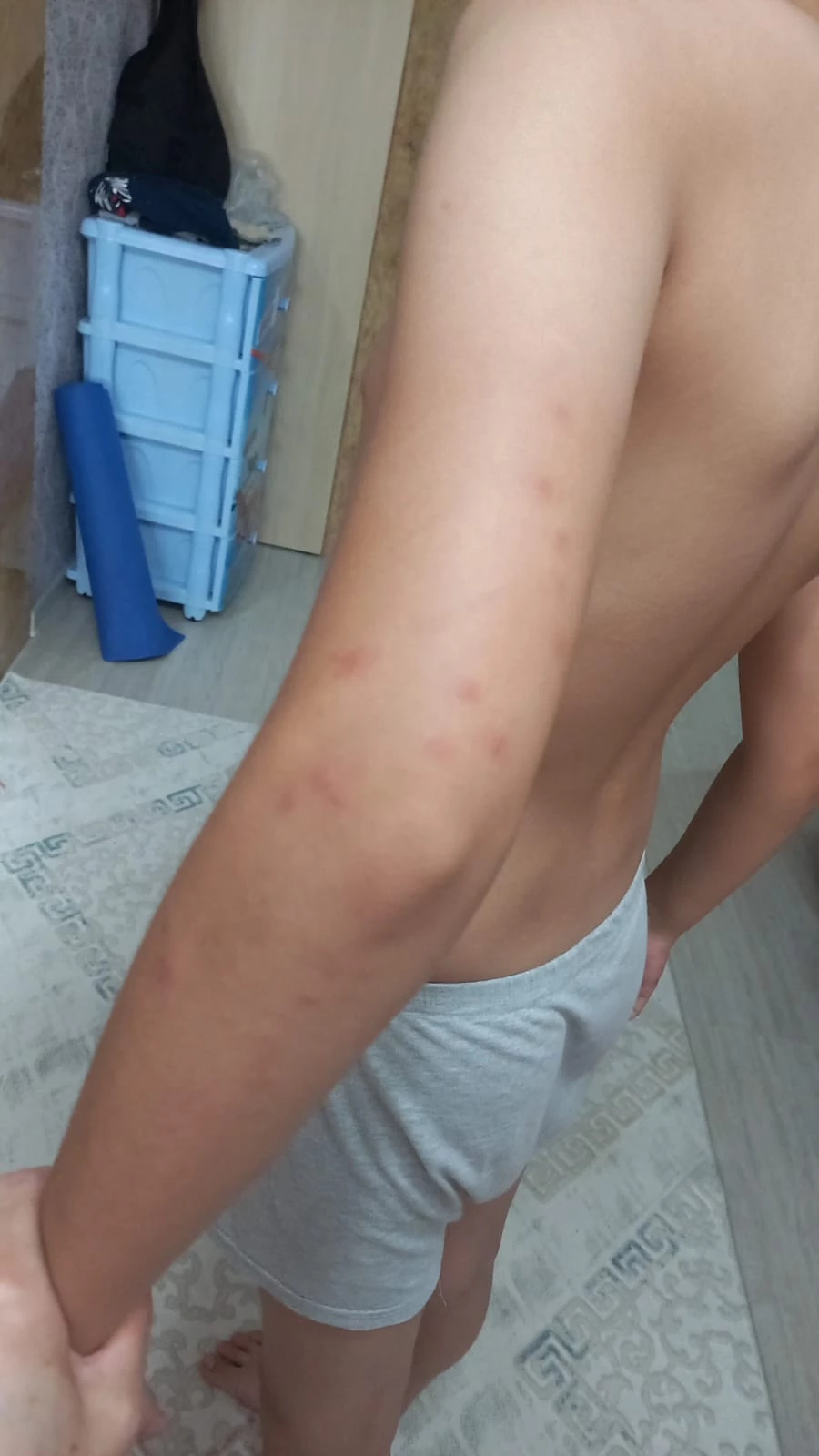 Ребенка покусали клопы в детском лагере Уральска